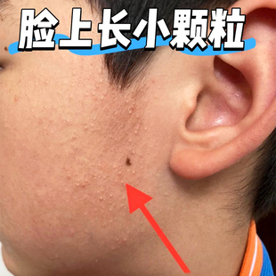 去脸上起小疙瘩脸颊两侧小颗粒颈部毛囊红斑黑变病闭口粉刺