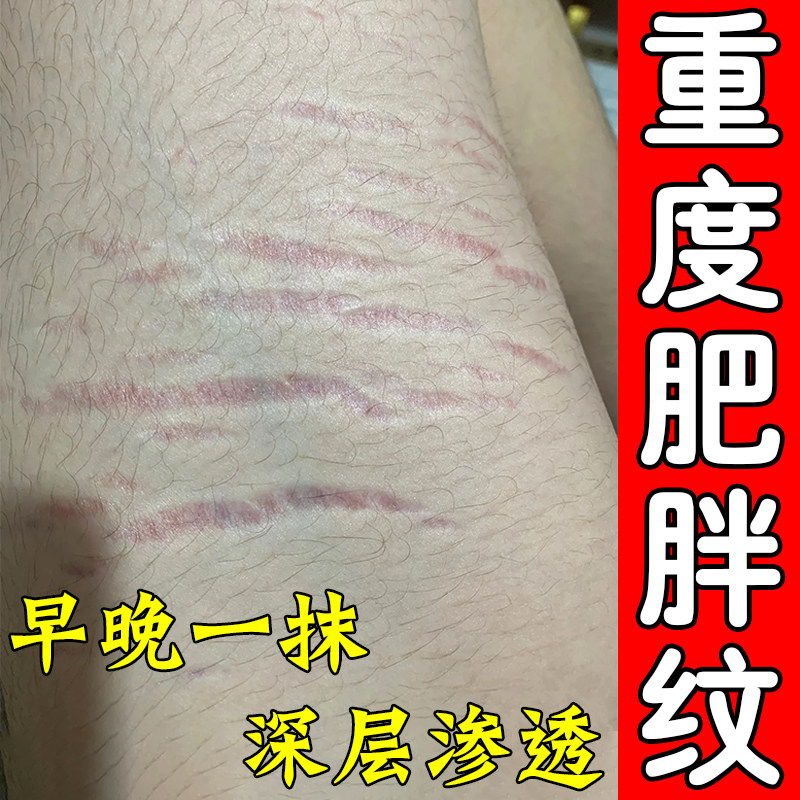 去肥胖纹修复霜生长纹消除学生大皮肤消毒护理（消）