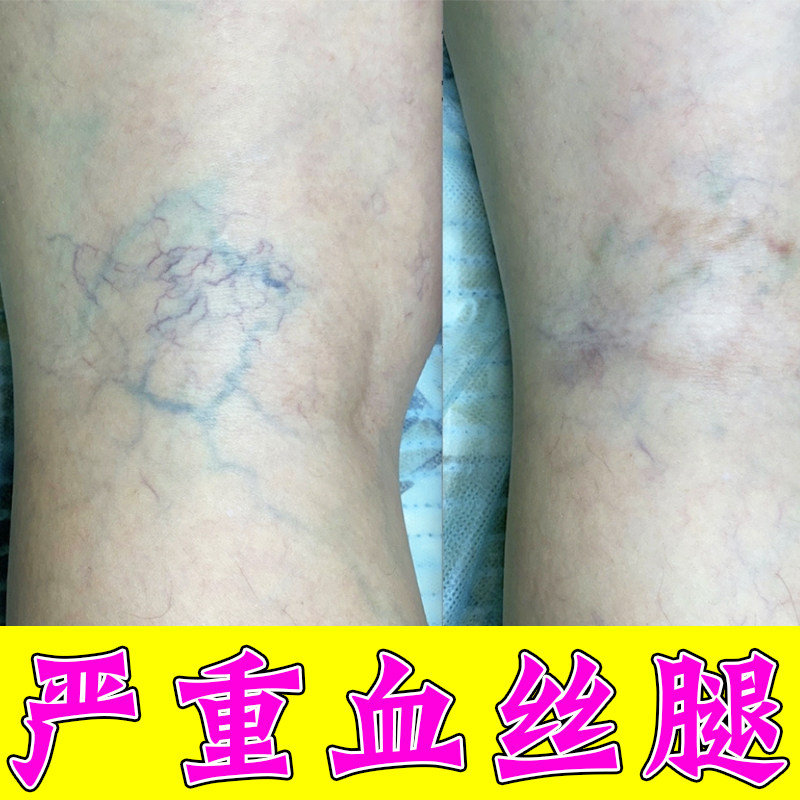 腿上有红血丝曲张冷敷凝胶去除男皮肤消毒护理（消）