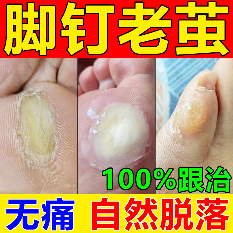 脚钉祛除膏去除厚脚垫老茧死皮根去脚底板脚掌趾指头硬皮软化剂药