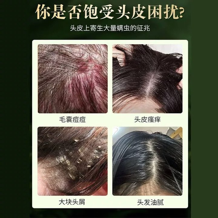 头痒有疙瘩毛囊炎中药洗发水疗治头部头皮上长痘痘止痒药专用