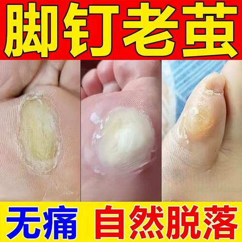 脚钉祛除膏去除厚脚垫老茧死皮根去脚底板脚掌趾指头硬皮软化剂药