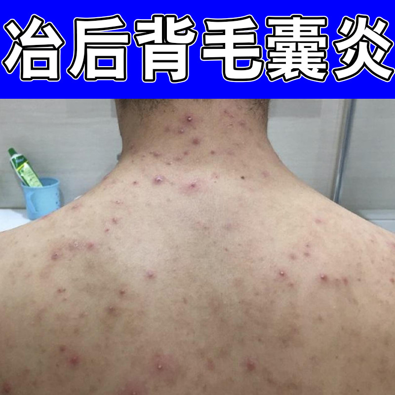 冶后背毛囊炎胸口起红疙瘩毛囊堵塞背上长脓包红点马拉色菌草本药