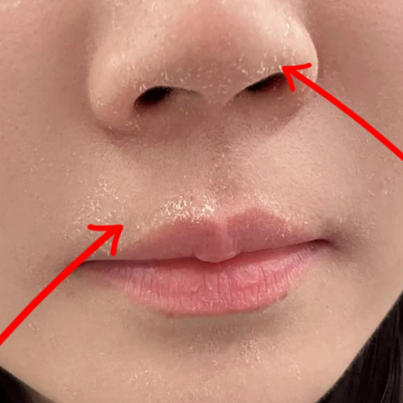 脸上起皮干皮脸干痒脸上脱皮掉皮皮肤泛红刺痛秋冬季皮肤干燥发痒