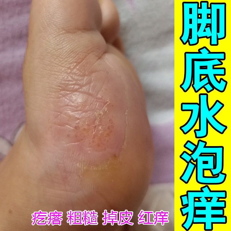 脚底水泡痒起皮蜂窝状脚底发白粗糙干燥松懈症专用草本痒药乳