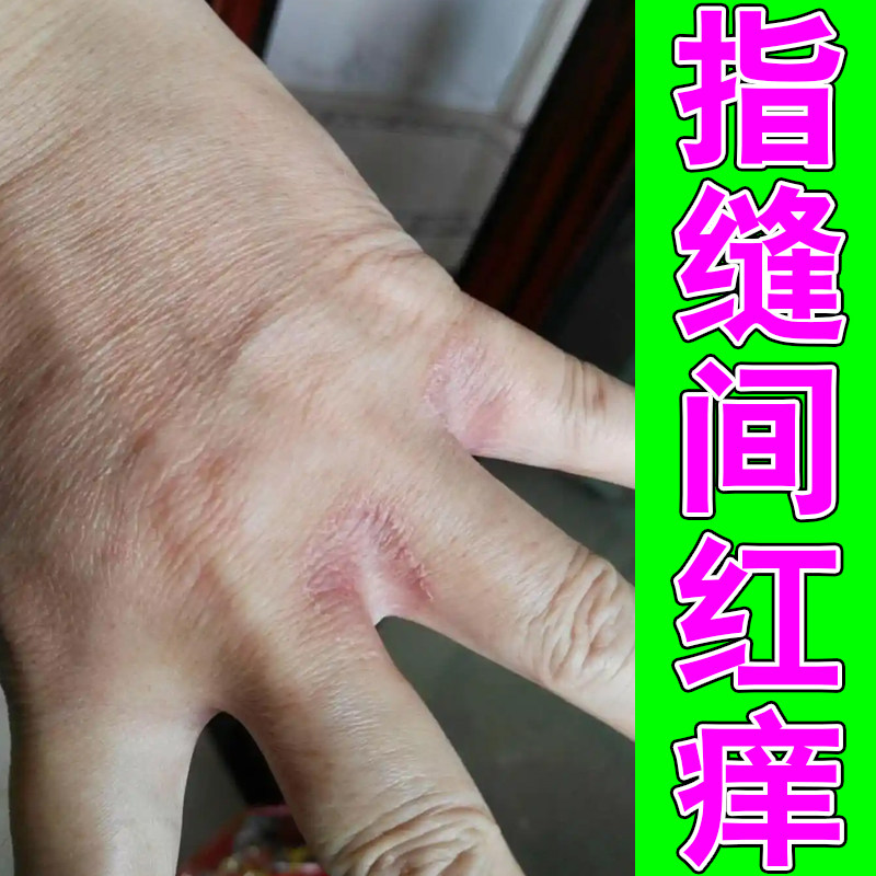 指缝间红痒手指间粗糙红肿手部泛红换季过敏手脱皮裂口掉屑修护药