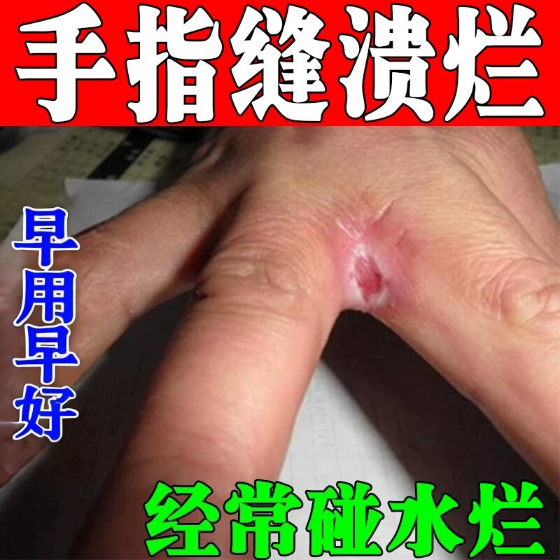 手指缝药专用软膏手指中间开裂脱皮疼痛水泡手痒