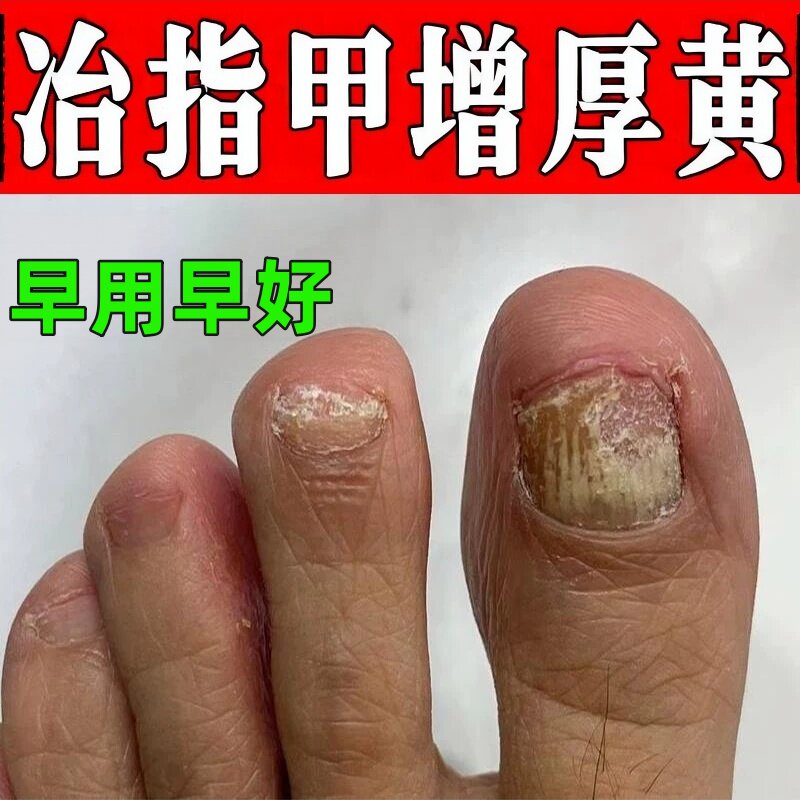 冶指甲增厚发黄重度厚甲控甲专用膏药脚趾甲变厚发黄专用草本药液