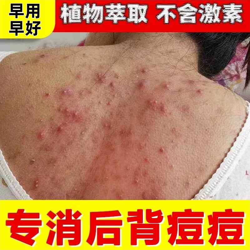 后背去螨虫痘黑头背部胸前胸口身体背上长痘痘除痘印神器