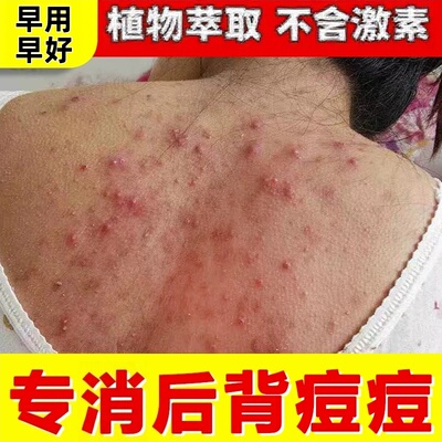 后背去螨虫痘黑头背部胸前胸口身体背上长痘痘除痘印神器