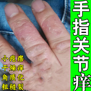 手指关节痒开裂药手指关节长硬疙瘩伤痒脱皮干裂口手痒膏