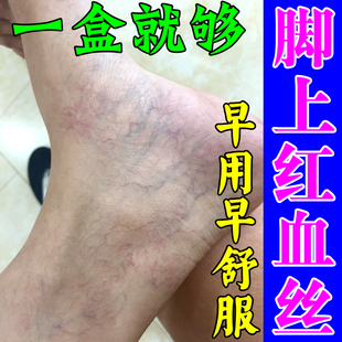 腿上有红血丝下肢血管青筋凸起蚯蚓腿专用冷敷凝胶