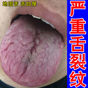 舌裂纹地图舌舌苔白厚灼烧肿胀开裂齿痕舌舌调理舌烂痛专用剂