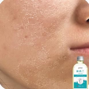 脸上干燥起皮脸干燥干皮脱皮干痒皮肤粗糙起干皮秋冬脸部掉皮发痒