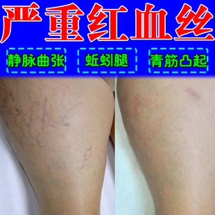 膏脉管下肢蚯蚓腿部精索青筋凸起女性腿红血丝血管肿胀