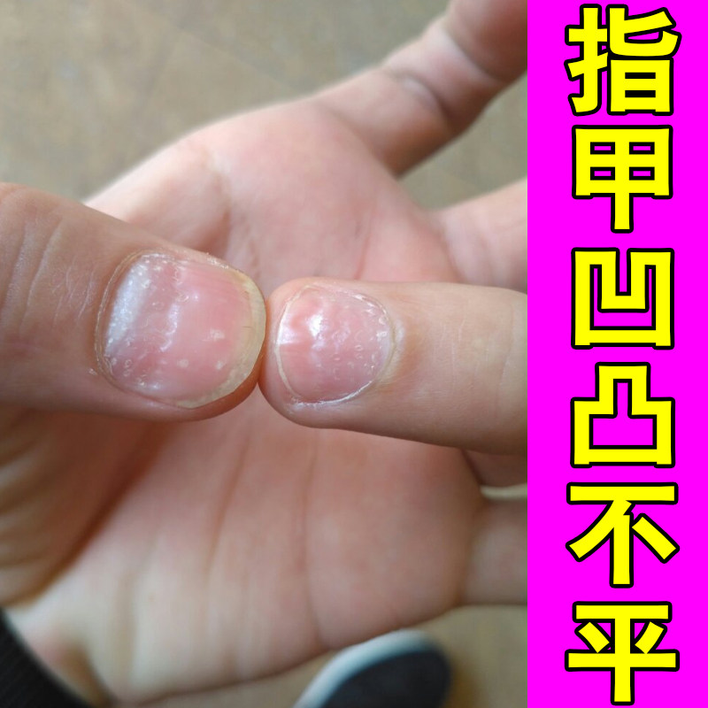 指甲凹凸不平甲受损萎缩甲顽固黄甲竖纹变黄真菌性白甲修护草本药