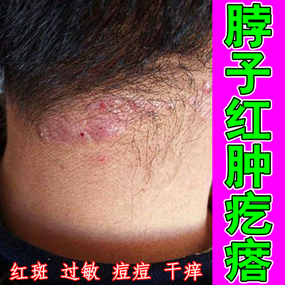 脖子红肿疙瘩颈部上长红豆豆疙瘩起皮掉屑冶神经性过敏痒鳞屑增厚
