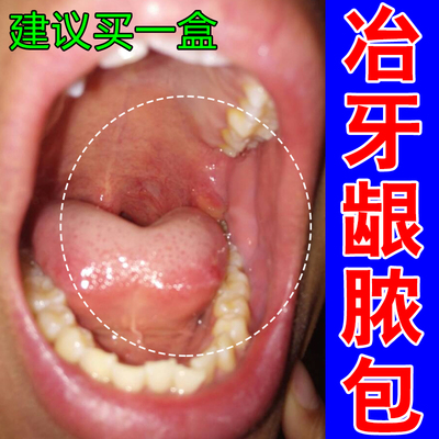 冶牙龈脓包牙肉红肿上火修护牙龈上火鼓包脓肿出血专用修复药乳膏