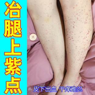 过敏性紫点皮下出血红点瘀斑四肢长红点瘀斑瘀点消腿上红点