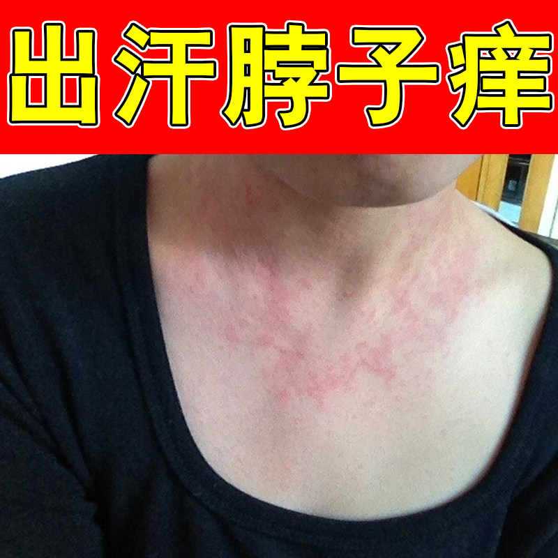 出汗脖子痒起疙瘩痘过敏刺挠一抓一片红干燥粗糙起疹子专用修护膏