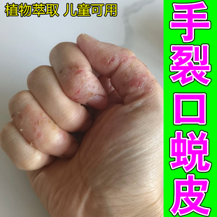 手裂口蜕皮手指头开裂起皮脱屑手上起皮干燥裂口子专用修复