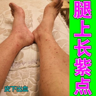 过敏性紫点老年人儿童身上长红点瘀斑瘀点四肢皮下出血专用修复
