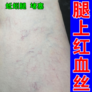 腿上有红血丝去男女下肢血管堵塞肿胀毛细血管扩张专用冷敷凝胶药