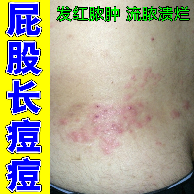 屁股坐板疮臀部起火疖子长痘痘疙瘩冒白尖脓包痒痛专用拔毒拔脓药