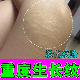 去肥胖纹修复霜生长纹消除学生大腿淡化妊娠纹精油祛紧致肚皮膏