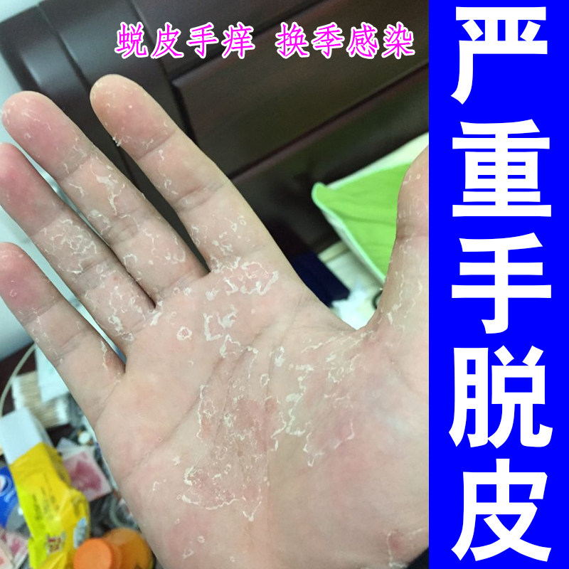 严重手脱皮掉屑红肿剥脱性角质松皮肤消毒护理（消）