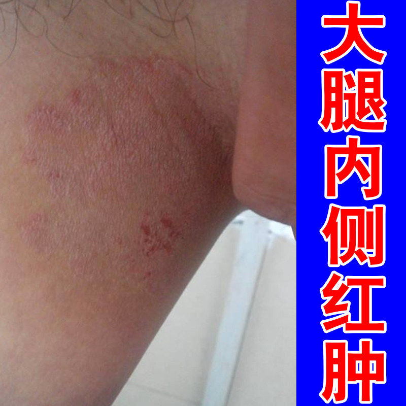 大腿内侧红肿男士胖人久坐走路磨裆根部出汗灼热烧裆下体潮湿泛红