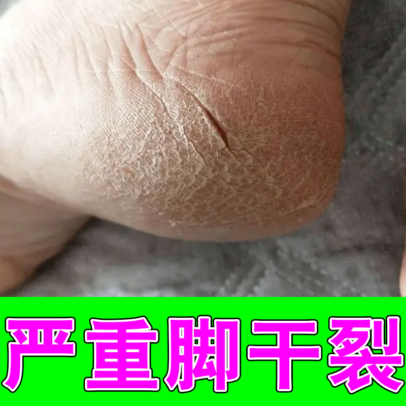 严重脚干裂脚后跟裂口子角化型粗糙干燥脱皮角质层增厚感染脚痒膏