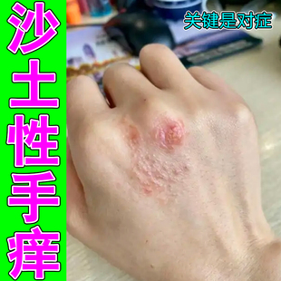 沙土性手痒手背疙瘩痒掉屑红肿紫外线过敏手上起小疙瘩红肿修护药