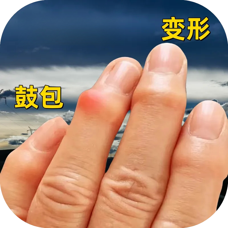 手指骨节肿疼粗大手指骨节肿胀疼痛指关节鼓包手指起疙瘩修复美手