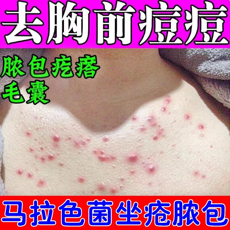 前胸后背长痘痘淡化背上长痘药乳