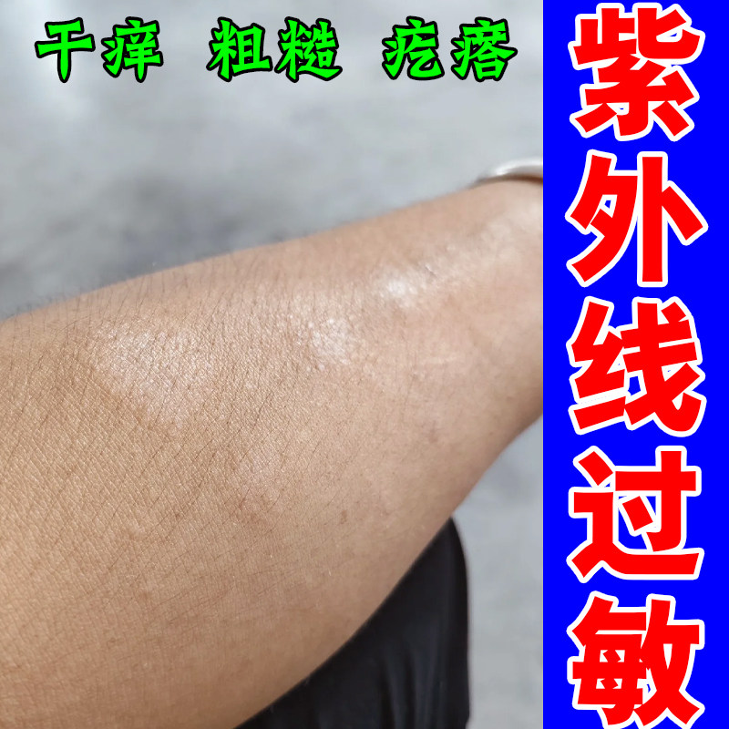 紫外线过敏手臂胳膊起疙瘩红痒晒伤脖子手背痒红肿神经性日光性皮