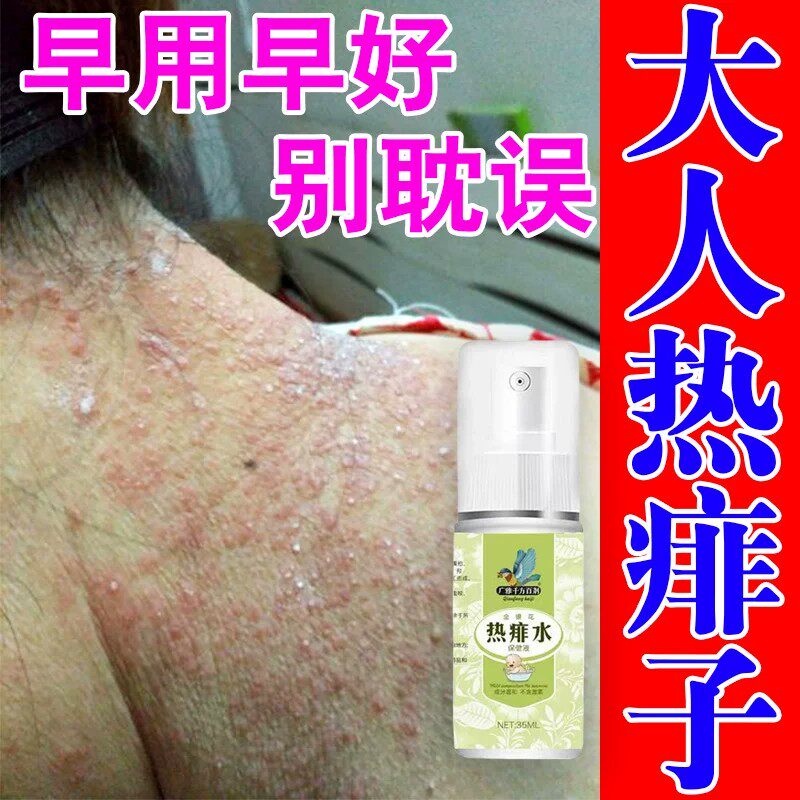 成人痱子水热痱水喷雾止儿童去痱药膏神器祛痱专用粉菲子一喷净痒