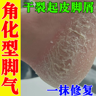 脚后跟干裂真菌感染起硬皮脱皮足跟开裂干燥脱皮鳞屑角化型修复霜