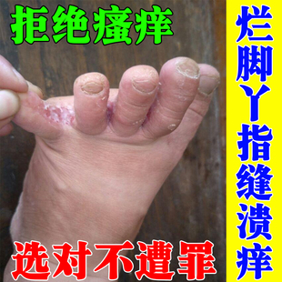脚气烂脚丫药脱皮糜烂痒脚趾缝溃烂真菌感染去脚臭水泡香港脚软膏