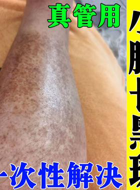 小腿长黑斑糖尿病引起小腿胫前黑斑糖斑烂足腿上疤痕伤疤黑色素