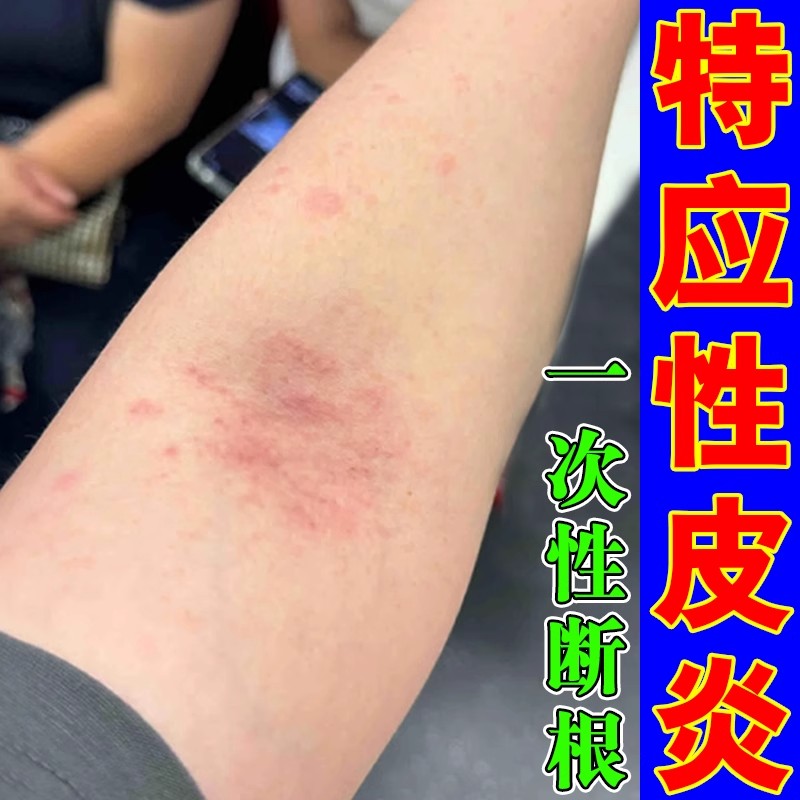 胳膊肘内侧痒起疙瘩小红点夏天天热肘窝皮肤过敏湿疹皮炎止痒抑菌
