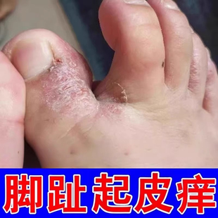 脚趾头起皮痒脚踝脚背痒脱皮糜烂缝脚趾干燥发痒男女香港脚出汗膏