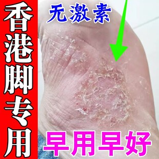 香港脚克星脚底板脱皮开裂烂脚丫脚痒足藓脚气根去专用效药特