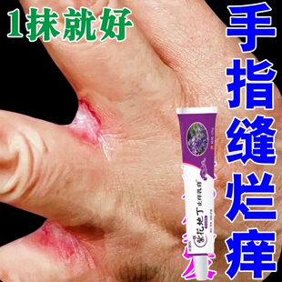 手指缝溃烂痒经常碰水烂手丫糜烂痒脱皮干裂疼痛手指缝红痒专用膏