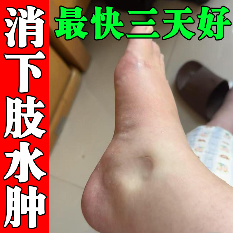 【当天消除】利尿排水肿去快速老膏药贴（器械）