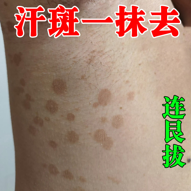 汗斑净去汗斑专用去胸前后背腋下白斑花斑藓褐色斑止痒膏专用杀菌