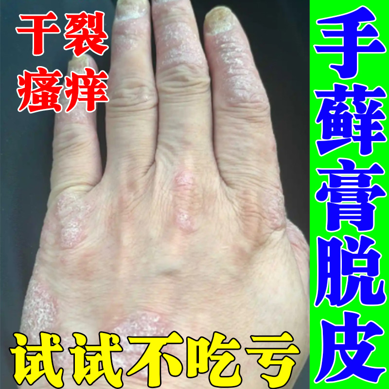 手指关节藓手藓膏真菌感染脱皮干裂增厚脱屑硬皮手指关节长硬疙瘩