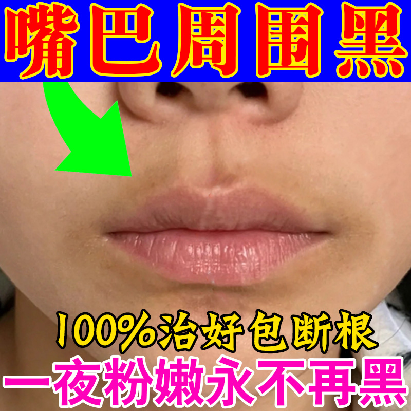 嘴唇黑色素去除改善唇周黑嘴角发黑发紫淡化唇色唇纹嘴巴暗沉唇膏