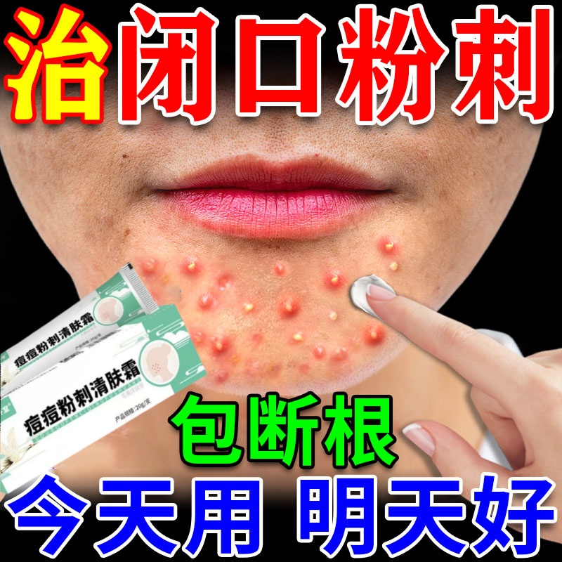 闭口粉刺的克星脸上起小疙瘩去除脸部治儿童下巴反复长痘药膏神器
