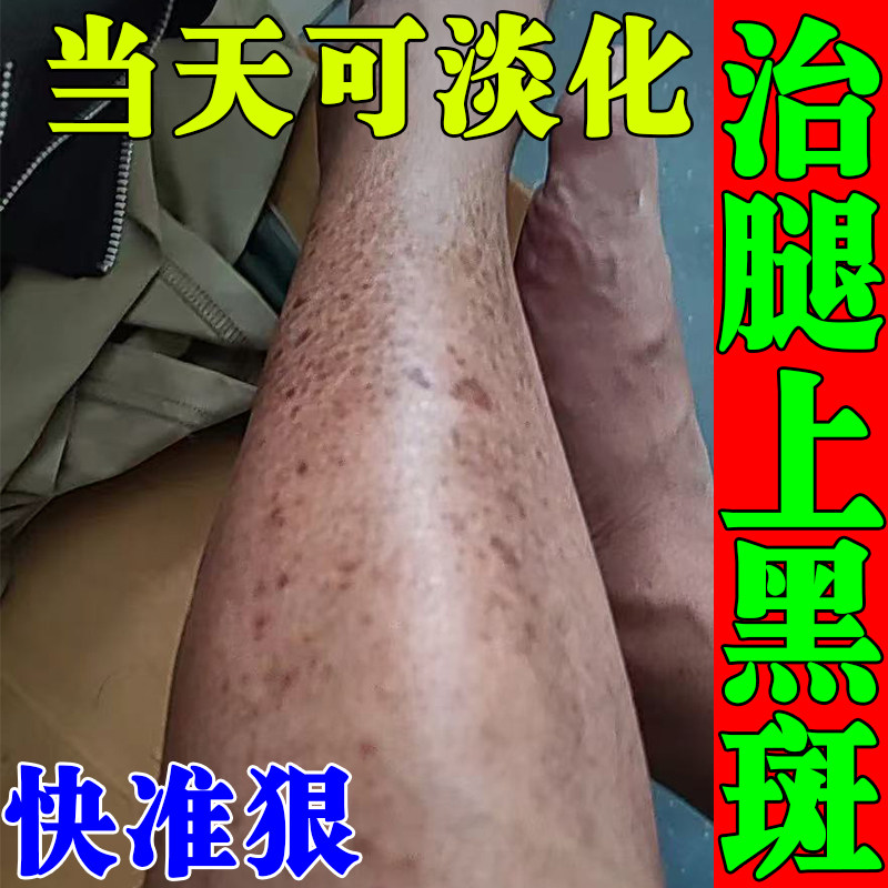 小腿长黑斑黑色素去除糖尿病引起小腿胫前黑斑糖斑烂足腿上疤痕膏